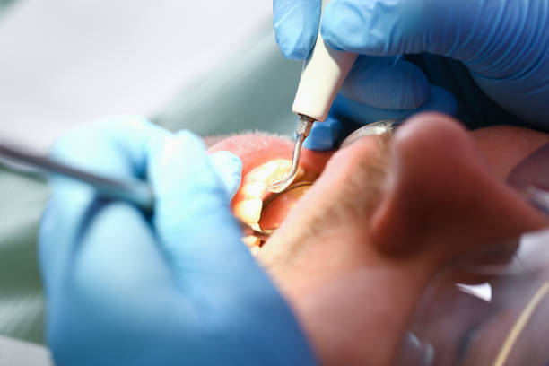 Best Emergency Root Canal Treatment in Nicholasville, KY