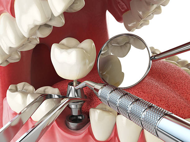 Best Emergency Dentist for Lost Fillings or Crowns in Nicholasville, KY
